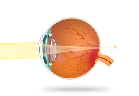 PRESBYOPIA - Red Dot Vision